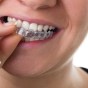 What Is Invisalign and How It&nbsp;Works?