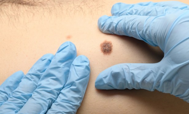 Expert Basal Cell Carcinoma Detection and Treatment at Wall&nbsp;Dermatology